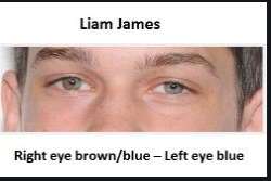 The actor is a patient of heterochromia iridium with the affect of which his one eye is green while the other is blue.